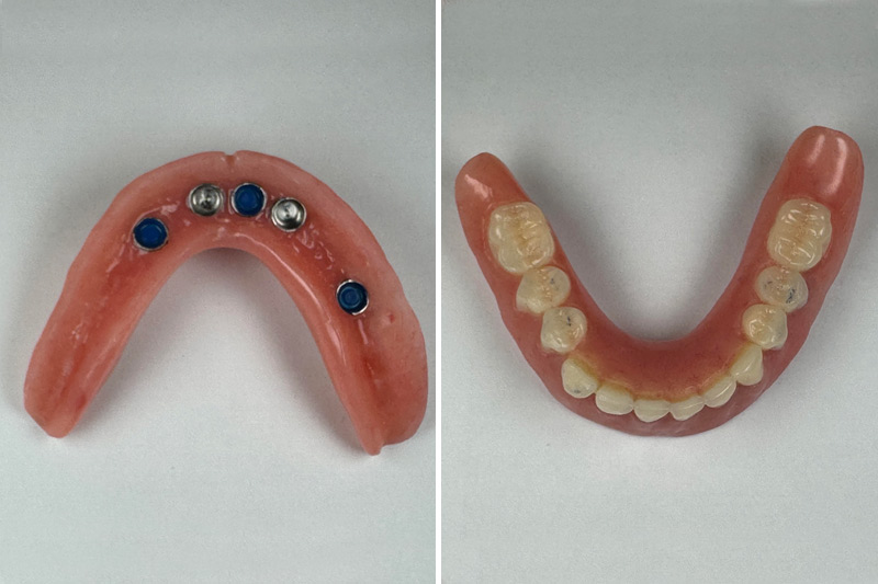 Overdentures in Parkville