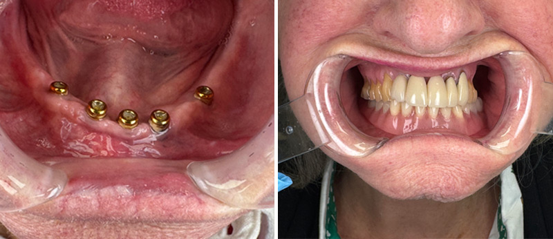 Overdentures in Parkville